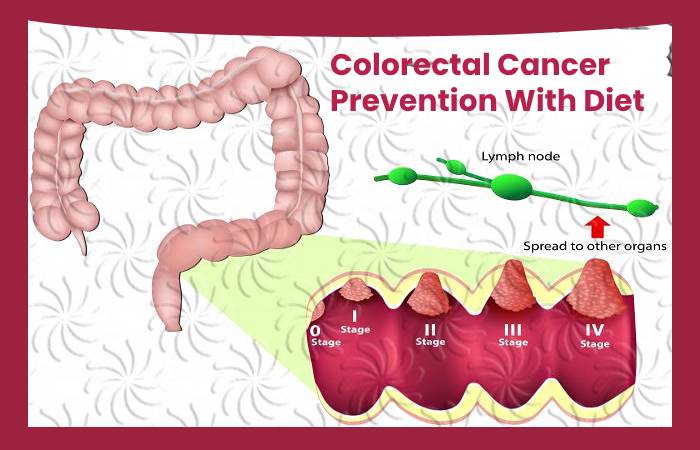 Colorectal Cancer Prevention With Diet