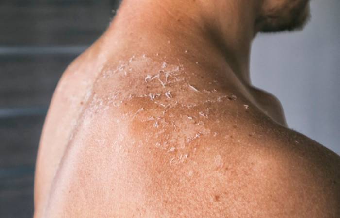 Epidermolysis Bullosa