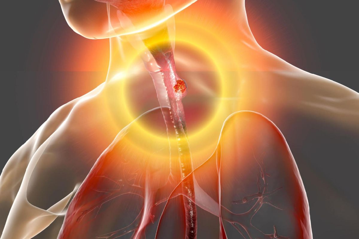 Dysphagia