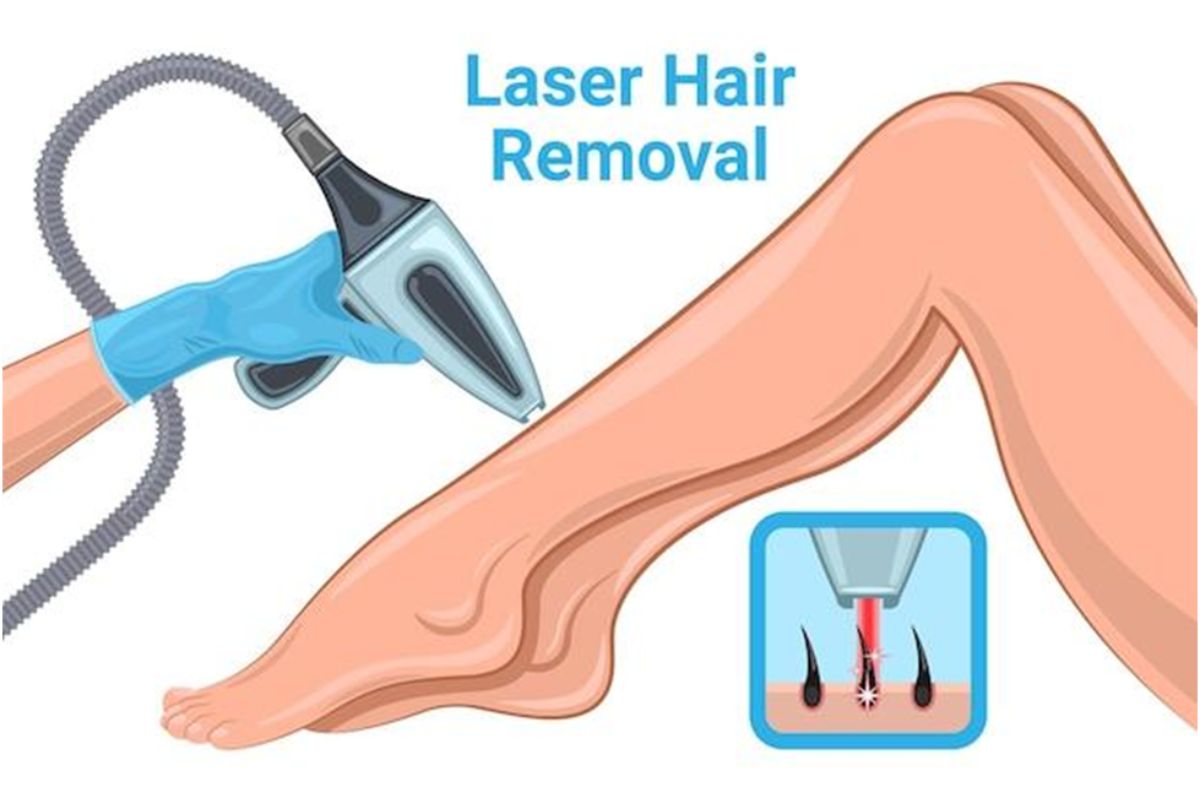 laser hair removal