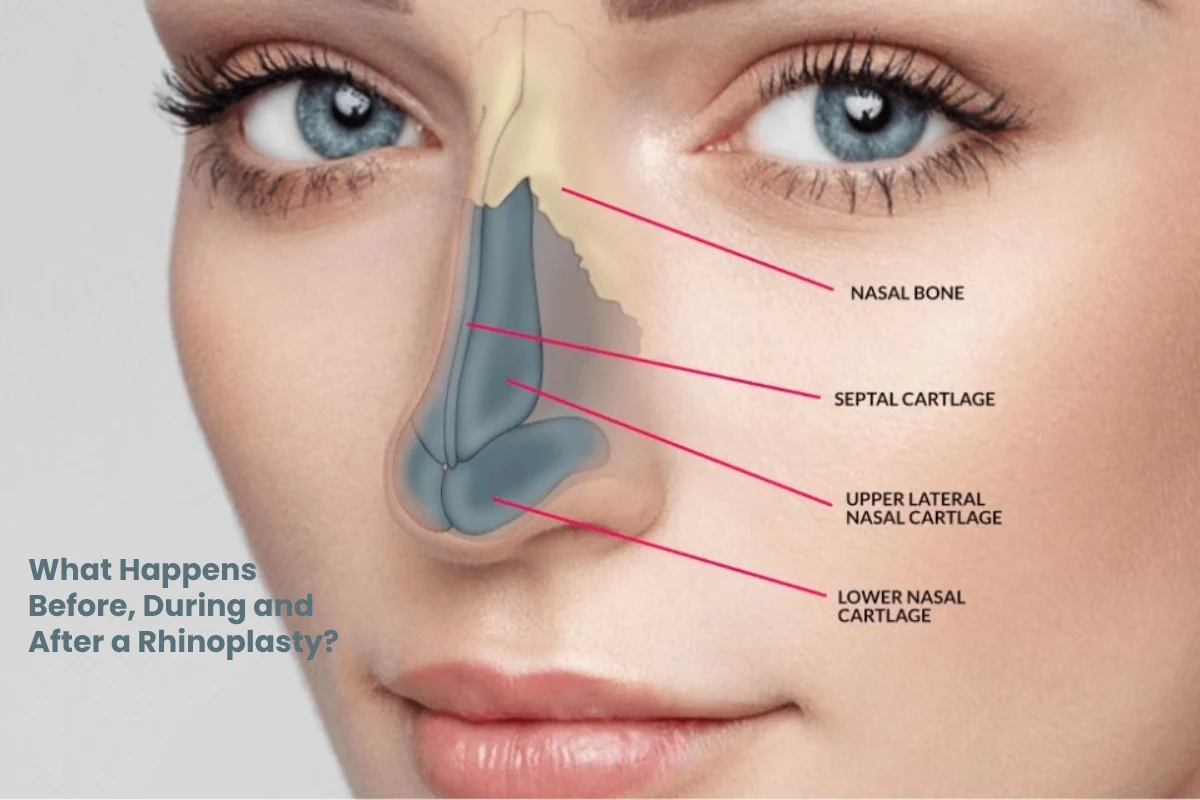 Rhinoplasty